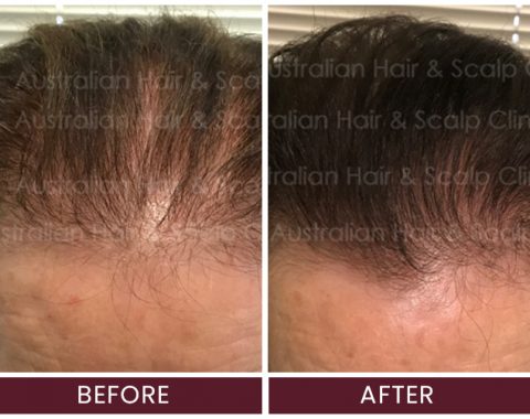 8 Month double dosage in clinic treatment