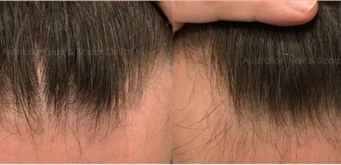 Male Frontal Hairline