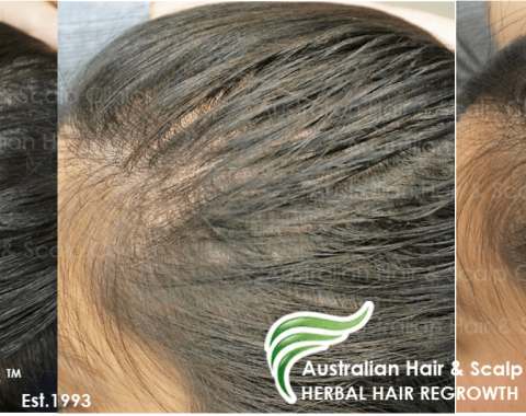 female temple hairline result