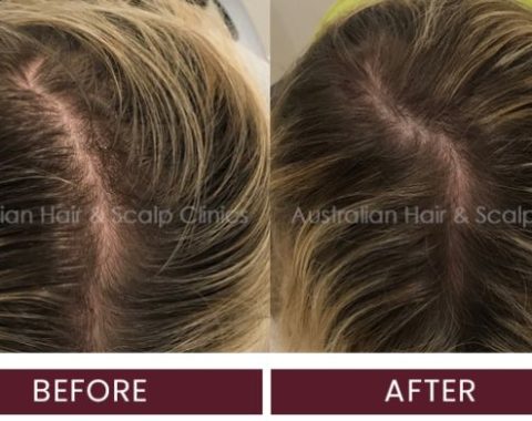 Female Crown area hair growth result