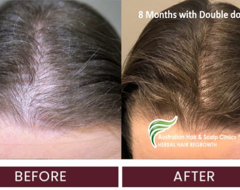female middle stage hairline results