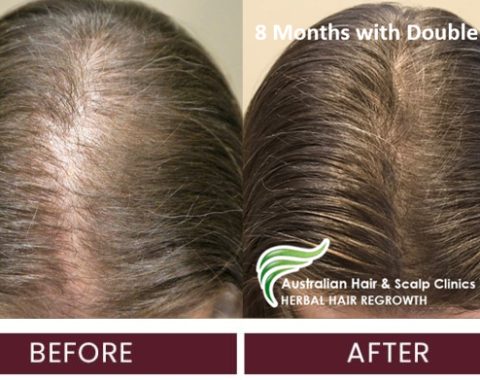 female middle stage hairline results